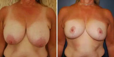 Breast Reduction Before & After Gallery - Patient 244254 - Image 1