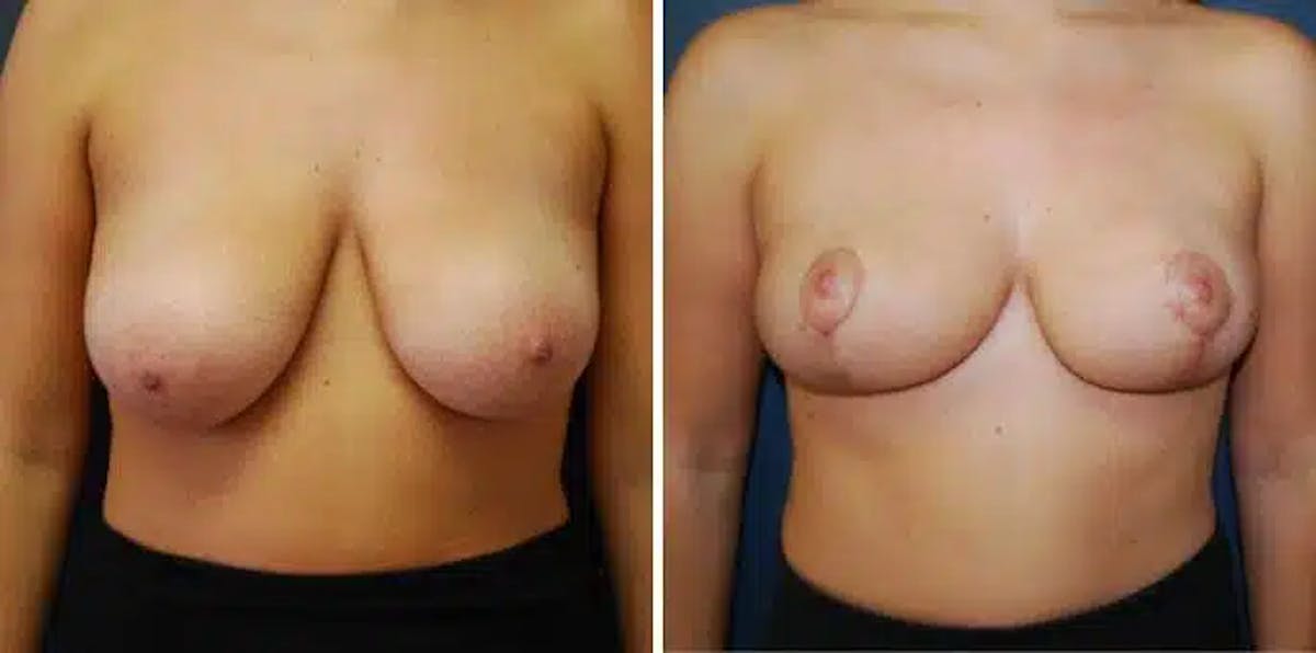 Breast Reduction Before & After Gallery - Patient 218318 - Image 1