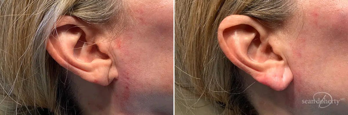 Dermal Fillers Before & After Gallery - Patient 501653 - Image 1