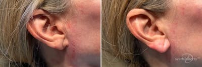 Dermal Fillers Before & After Gallery - Patient 501653 - Image 1