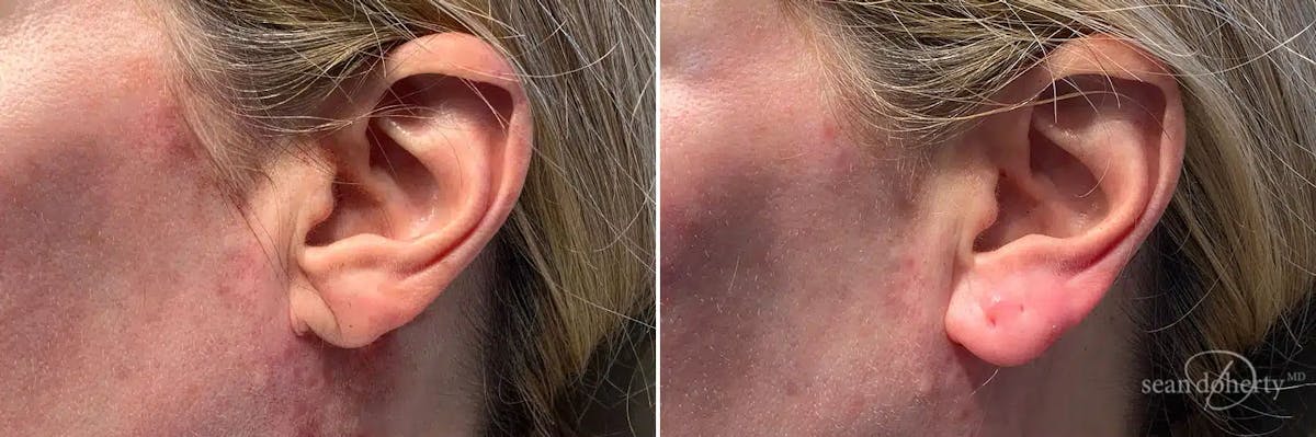 Dermal Fillers Before & After Gallery - Patient 501653 - Image 2