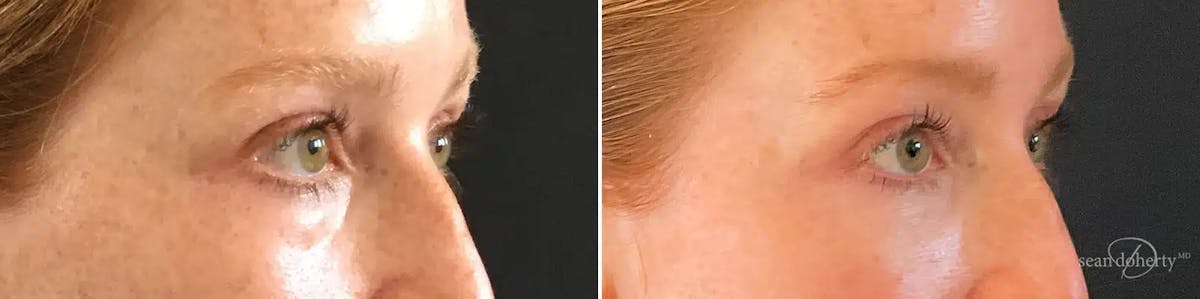 Dermal Fillers Before & After Gallery - Patient 464313 - Image 2