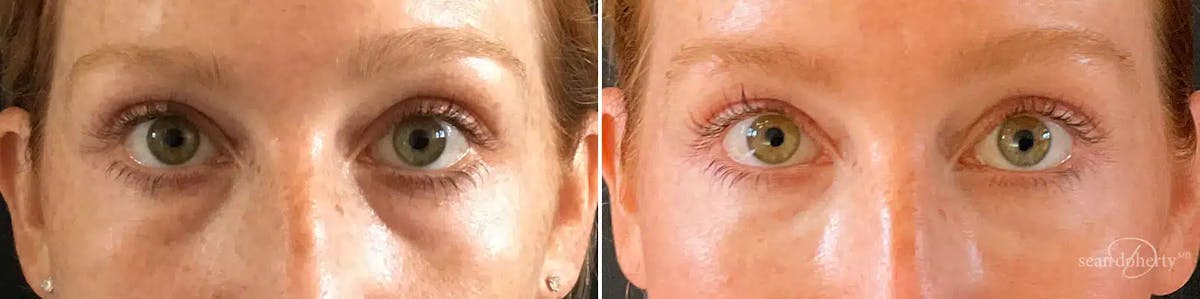 Dermal Fillers Before & After Gallery - Patient 464313 - Image 1