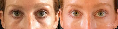 Dermal Fillers Before & After Gallery - Patient 464313 - Image 1