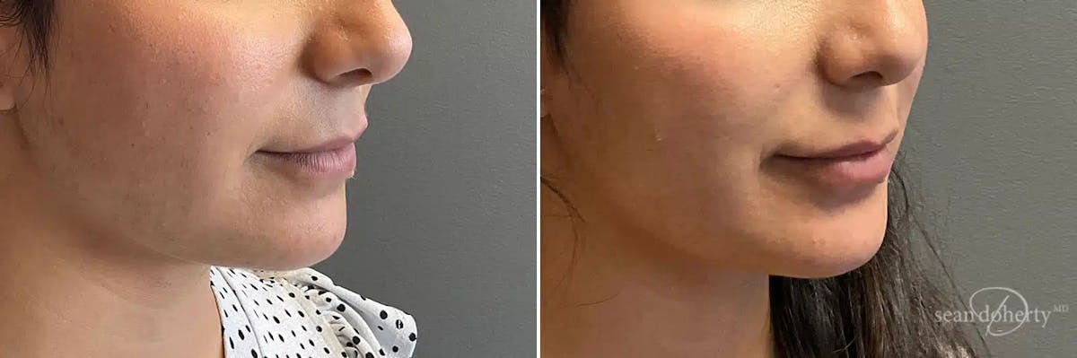 Dermal Fillers Before & After Gallery - Patient 130673 - Image 2