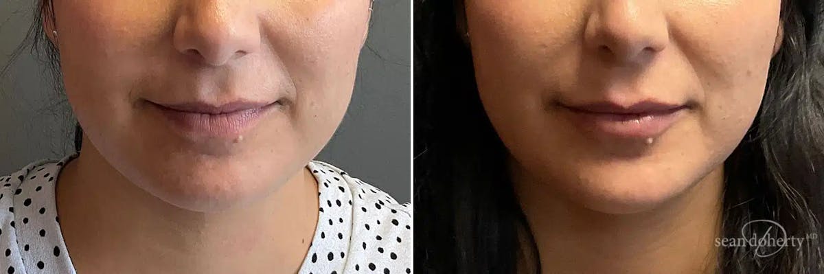 Dermal Fillers Before & After Gallery - Patient 130673 - Image 1
