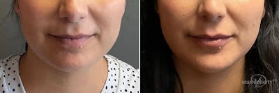 Dermal Fillers Before & After Gallery - Patient 130673 - Image 1