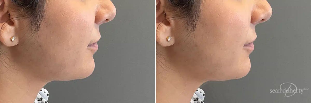 Dermal Fillers Before & After Gallery - Patient 130673 - Image 3