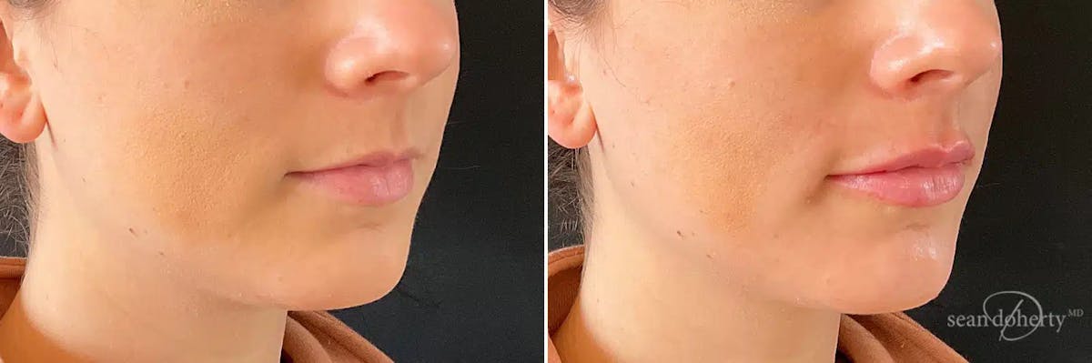 Dermal Fillers Before & After Gallery - Patient 290661 - Image 2