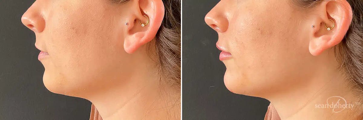 Dermal Fillers Before & After Gallery - Patient 290661 - Image 3