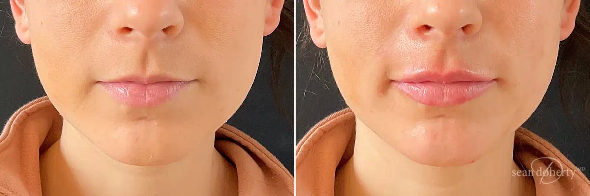 Dermal Fillers Before & After Gallery - Patient 290661 - Image 1