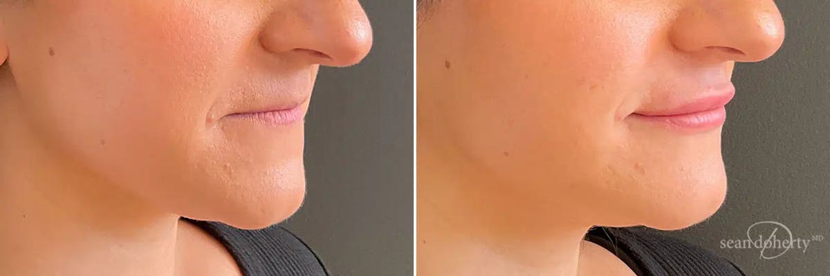 Dermal Fillers Before & After Gallery - Patient 417247 - Image 2