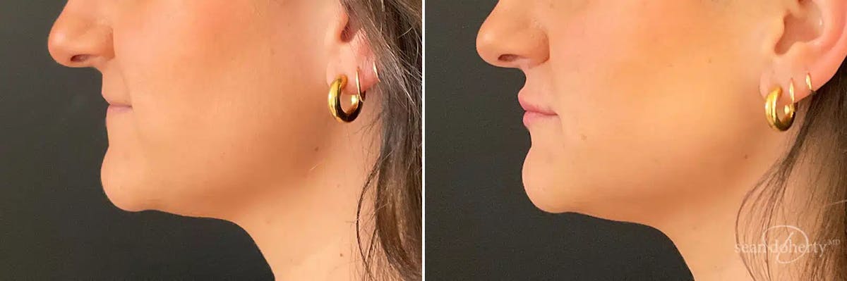 Dermal Fillers Before & After Gallery - Patient 417247 - Image 3