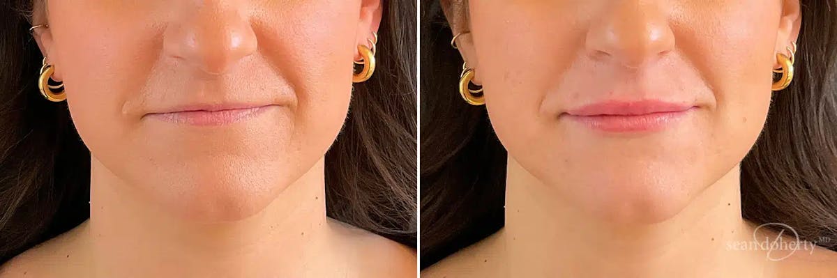 Dermal Fillers Before & After Gallery - Patient 417247 - Image 1