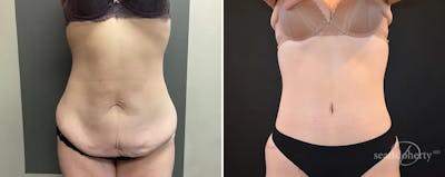 Abdominoplasty (Tummy Tuck) Before & After Gallery - Patient 536011 - Image 1