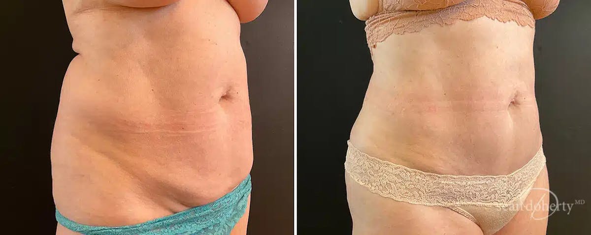 Abdominoplasty (Tummy Tuck) Before & After Gallery - Patient 285728 - Image 2
