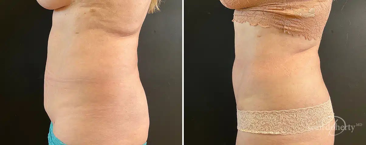 Abdominoplasty (Tummy Tuck) Before & After Gallery - Patient 285728 - Image 3