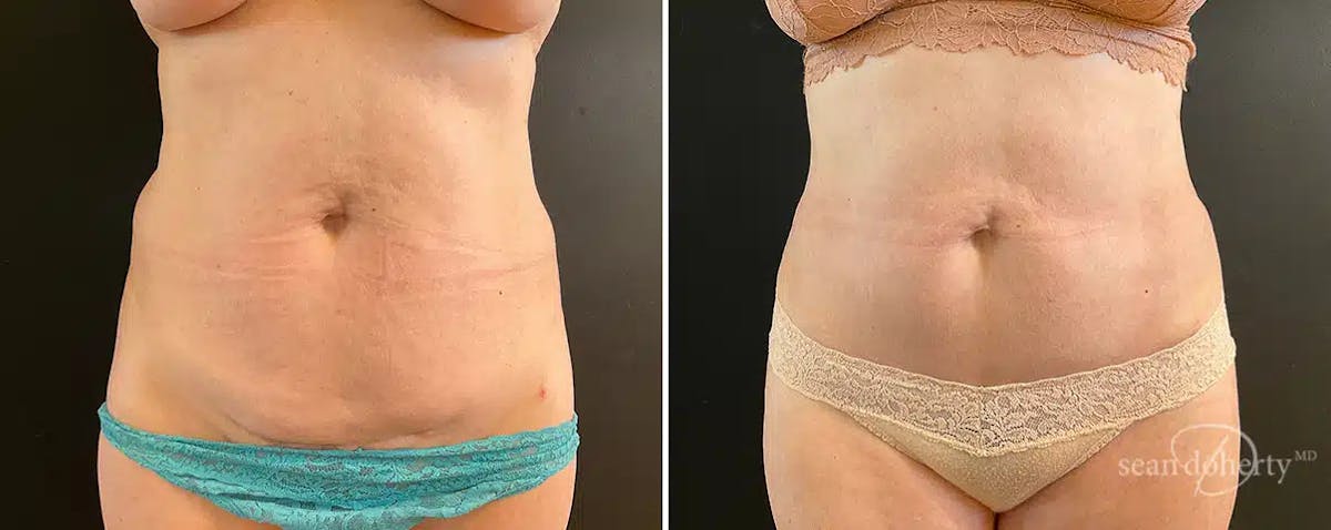 Abdominoplasty (Tummy Tuck) Before & After Gallery - Patient 285728 - Image 1