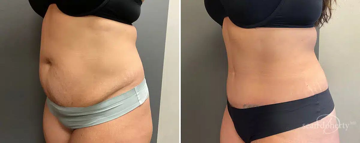 Abdominoplasty (Tummy Tuck) Before & After Gallery - Patient 425895 - Image 2