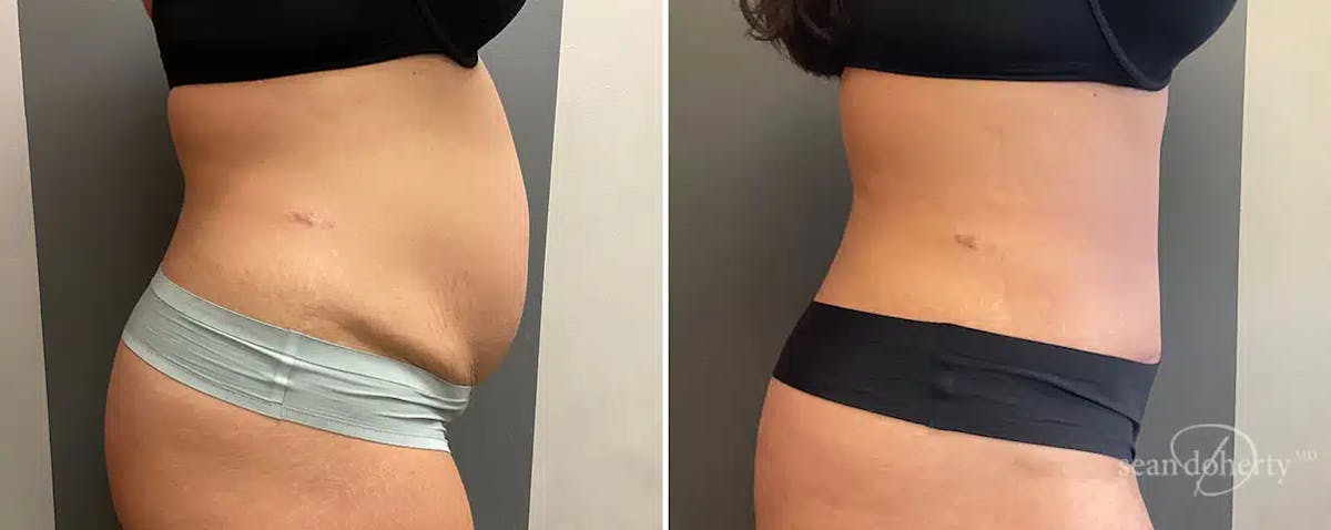 Abdominoplasty (Tummy Tuck) Before & After Gallery - Patient 425895 - Image 3