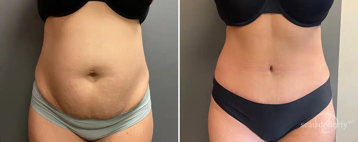 Abdominoplasty (Tummy Tuck) Before & After Gallery - Patient 425895 - Image 1