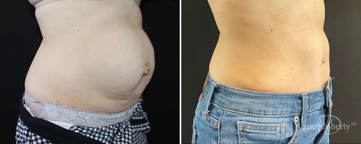 Abdominoplasty (Tummy Tuck) Before & After Gallery - Patient 208209 - Image 2
