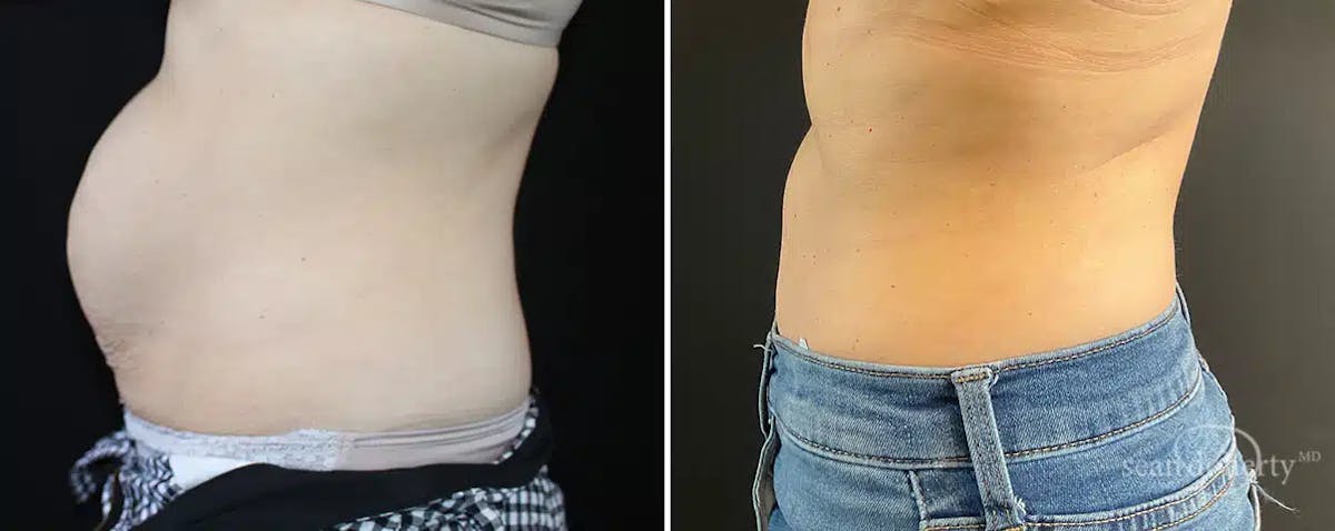 Abdominoplasty (Tummy Tuck) Before & After Gallery - Patient 208209 - Image 3