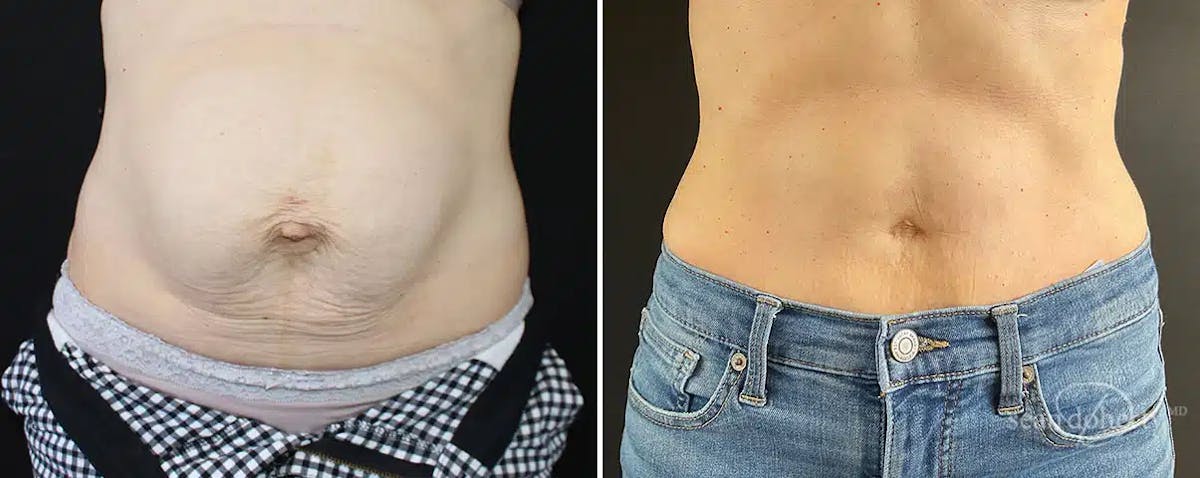 Abdominoplasty (Tummy Tuck) Before & After Gallery - Patient 208209 - Image 1