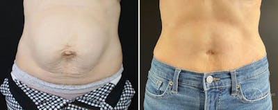 Abdominoplasty (Tummy Tuck) Before & After Gallery - Patient 208209 - Image 1