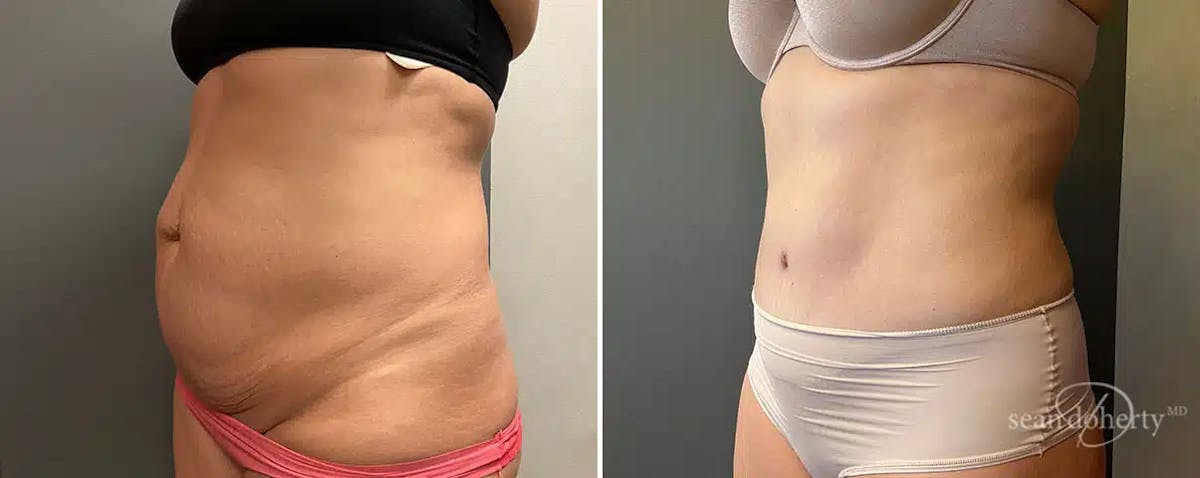 Abdominoplasty (Tummy Tuck) Before & After Gallery - Patient 798162 - Image 2
