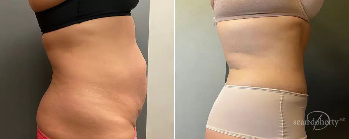 Abdominoplasty (Tummy Tuck) Before & After Gallery - Patient 798162 - Image 3