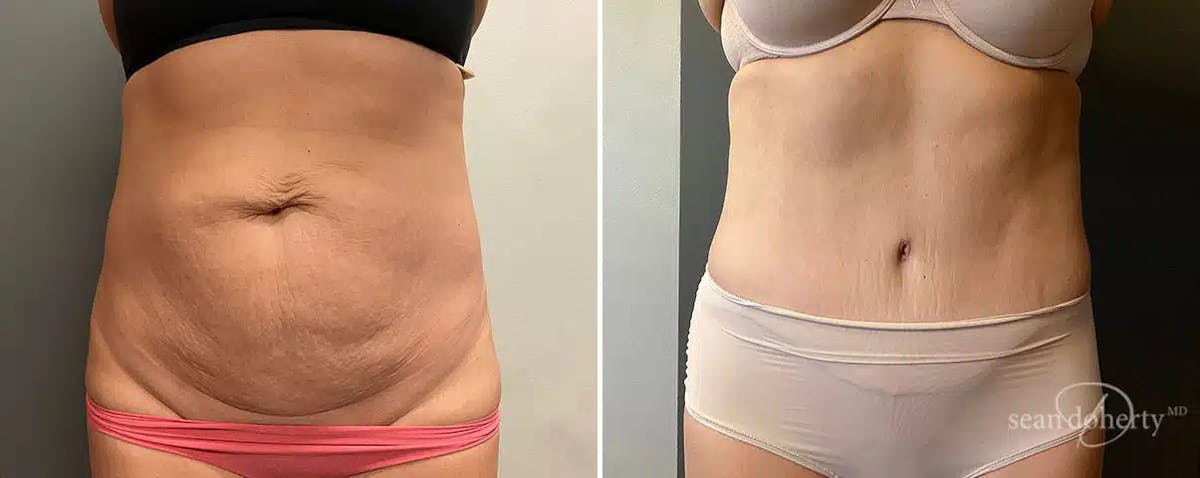 Abdominoplasty (Tummy Tuck) Before & After Gallery - Patient 798162 - Image 1