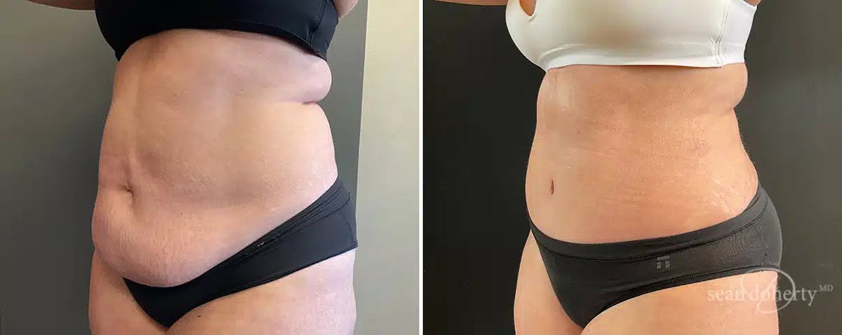 Abdominoplasty (Tummy Tuck) Before & After Gallery - Patient 365828 - Image 2