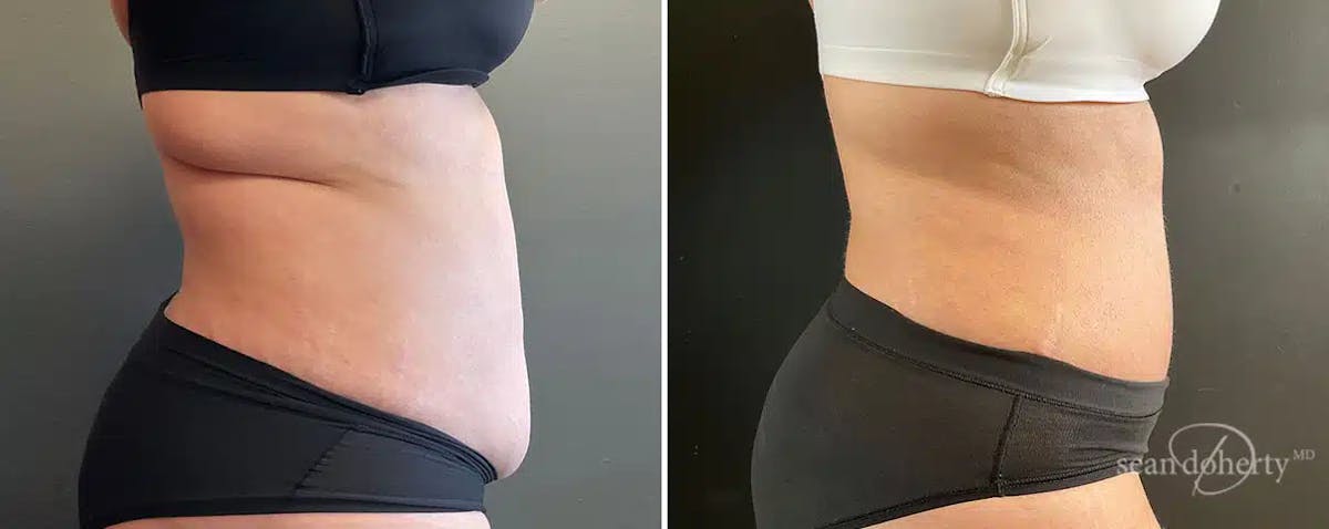 Abdominoplasty (Tummy Tuck) Before & After Gallery - Patient 365828 - Image 3