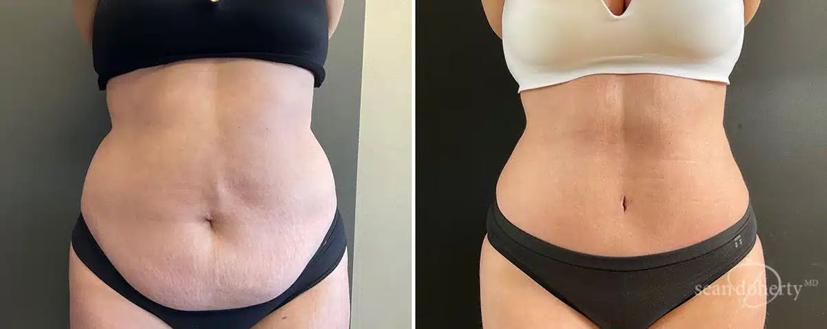 Abdominoplasty (Tummy Tuck) Before & After Gallery - Patient 365828 - Image 1