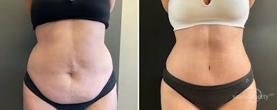 Abdominoplasty (Tummy Tuck) Before & After Gallery - Patient 365828 - Image 1