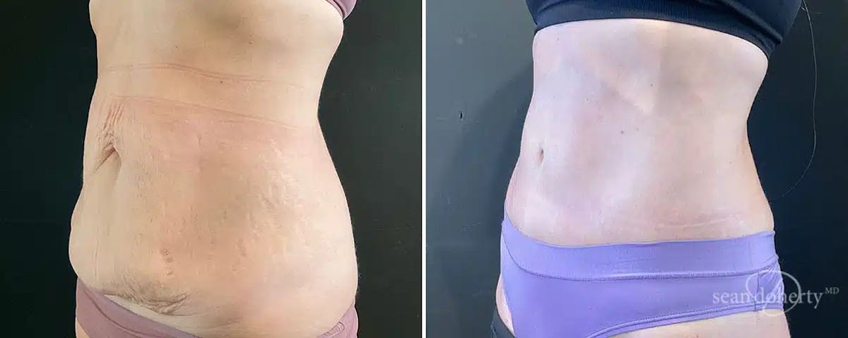 Abdominoplasty (Tummy Tuck) Before & After Gallery - Patient 329228 - Image 2