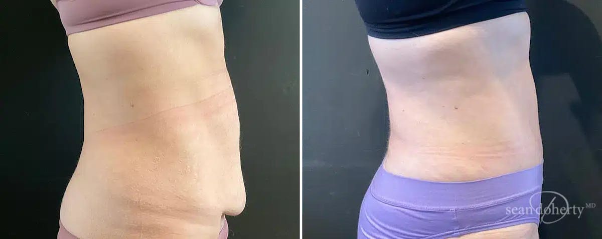 Abdominoplasty (Tummy Tuck) Before & After Gallery - Patient 329228 - Image 3