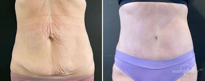 Abdominoplasty (Tummy Tuck) Before & After Gallery - Patient 329228 - Image 1