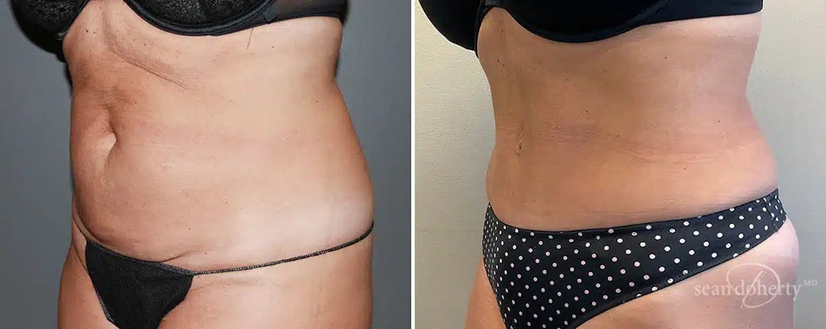 Abdominoplasty (Tummy Tuck) Before & After Gallery - Patient 292694 - Image 2