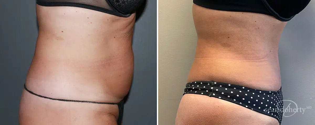 Abdominoplasty (Tummy Tuck) Before & After Gallery - Patient 292694 - Image 3