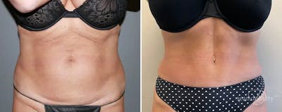 Abdominoplasty (Tummy Tuck) Before & After Gallery - Patient 292694 - Image 1