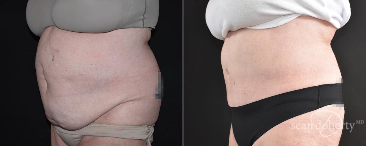 Abdominoplasty (Tummy Tuck) Before & After Gallery - Patient 109263 - Image 2