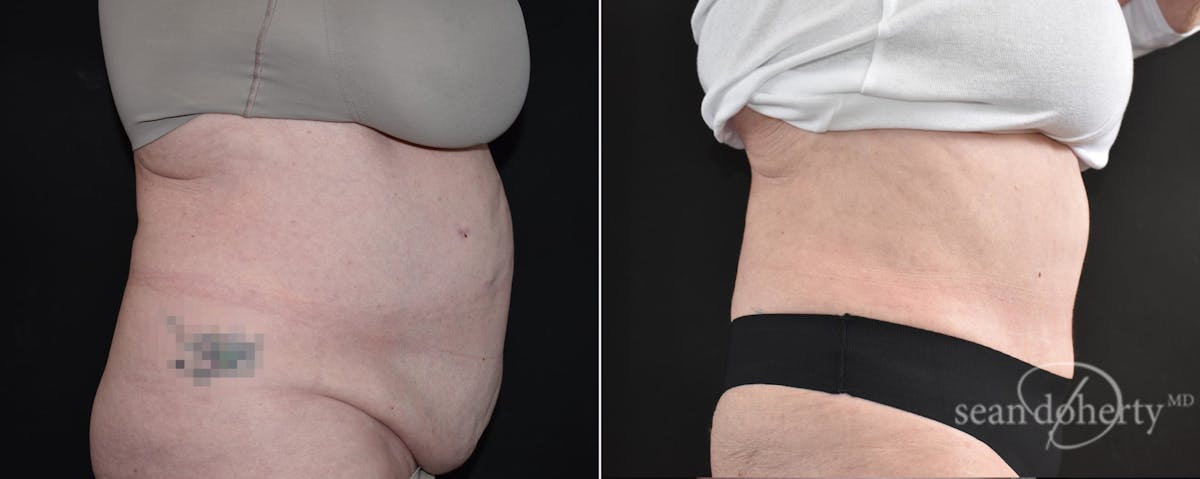 Abdominoplasty (Tummy Tuck) Before & After Gallery - Patient 109263 - Image 3