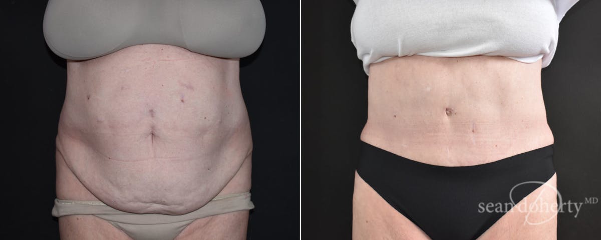 Abdominoplasty (Tummy Tuck) Before & After Gallery - Patient 109263 - Image 1