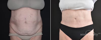Abdominoplasty (Tummy Tuck) Before & After Gallery - Patient 109263 - Image 1