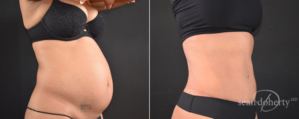 Abdominoplasty (Tummy Tuck) Before & After Gallery - Patient 225530 - Image 2