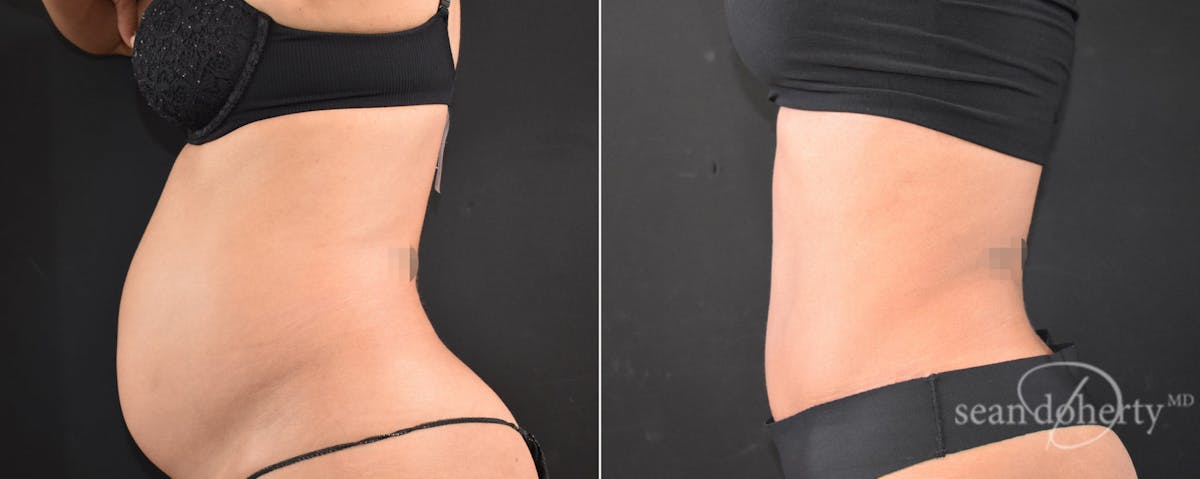 Abdominoplasty (Tummy Tuck) Before & After Gallery - Patient 225530 - Image 3