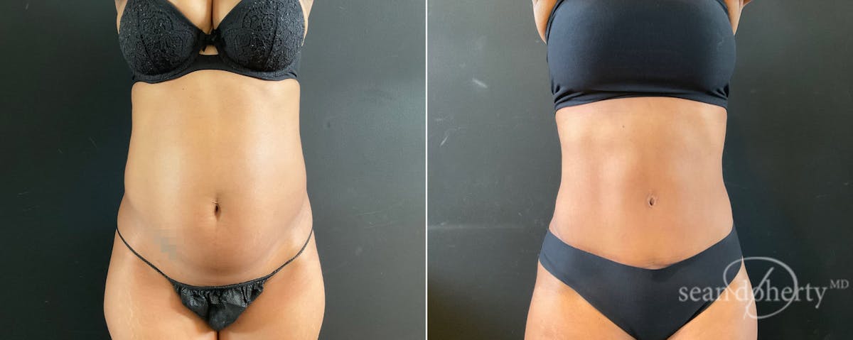 Abdominoplasty (Tummy Tuck) Before & After Gallery - Patient 225530 - Image 1