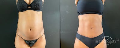 Abdominoplasty (Tummy Tuck) Before & After Gallery - Patient 225530 - Image 1